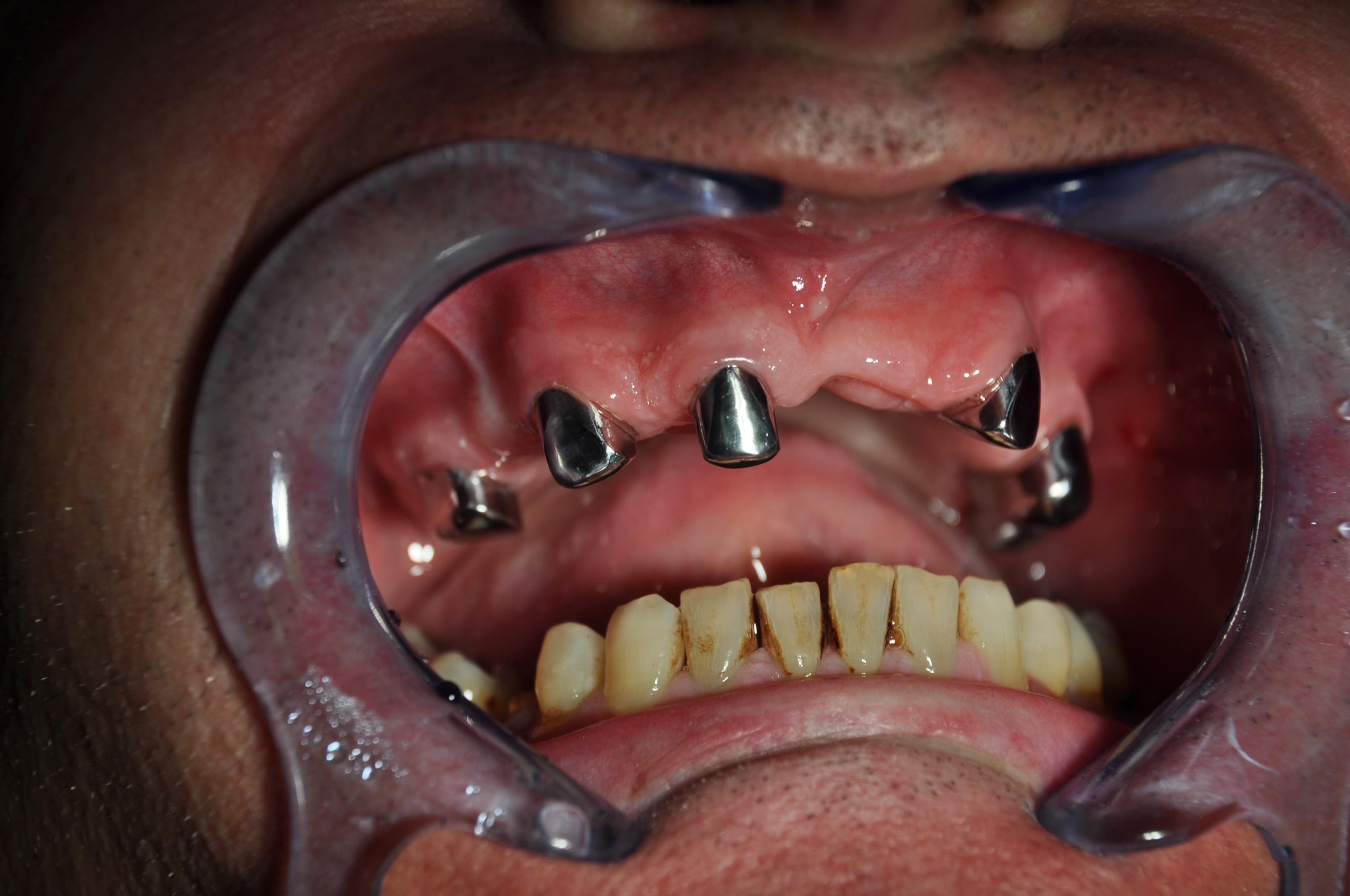 how much does a full set of teeth implants cost