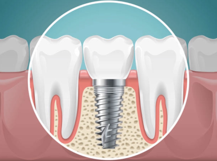 tooth implant picture