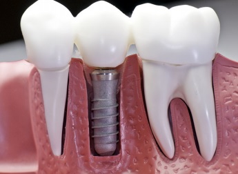 Teeth implant picture
