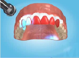 Teeth are whitened by the lamp