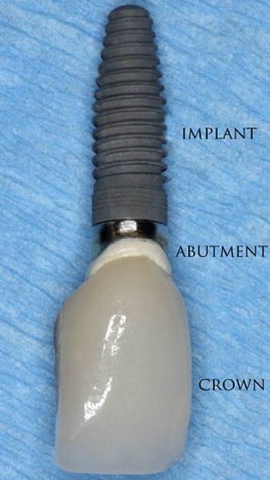 Tooth implant 