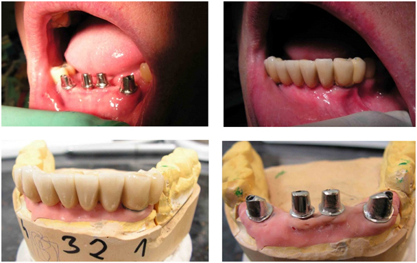 Results of dental implants procedures abroad